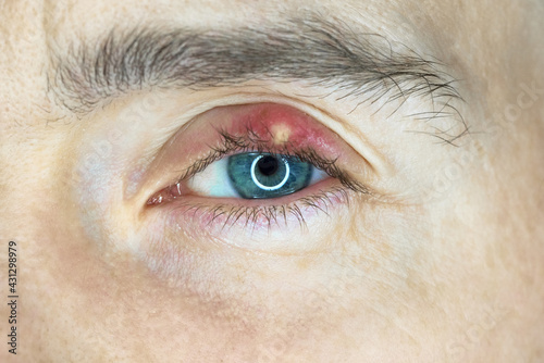 Chalazion on eye. Eyelid infection photo