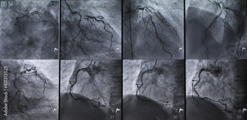 Coronary angiogram (CAG) was performed left and right coronary artery stenosis in multiple views. photo