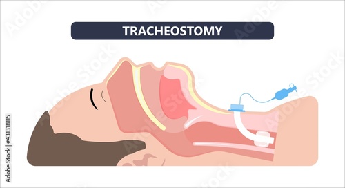 tube oxygen lungs face mask airway breathing trachea neck machine medical surgery ICU care unit ARDS Acute edema nursing suction catheter injury stoma disease coma obstructive sleep apnea blocked 19