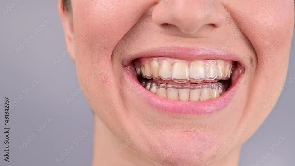 Close-up portrait of Caucasian woman smiling in night transparent retainers. Bite correction with removable braces Close-up portrait of Caucasian woman smiling in night transparent retainers. Bite correction with removable braces