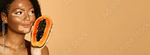 Woman with vitiligo has papaya in her hands, beige background. Concept of moisturizing and pampering skin with papaya cream