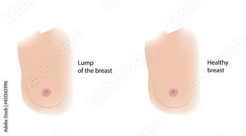 Woman healthy breast and Lump. Comparison. Medical vector illustration.
