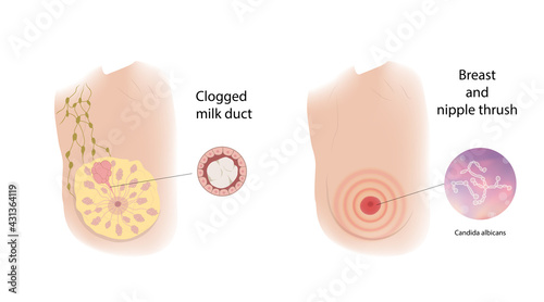 Woman breast and nipple thrush, Clogged milk duct. Comparison. Medical vector illustration.