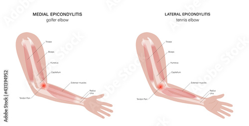 Lateral medial epicondylitis