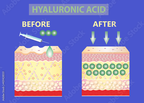 Hyaluronic acid. skin-care products. skin rejuvenation
