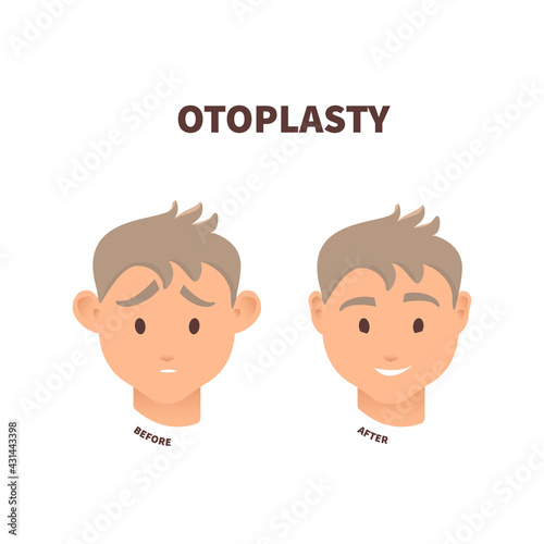 Cosmetic facial plastic ear surgery for men. Before and after otoplasty surgical correction procedure. Pinnaplasty ear pinning reshaping design template. Medical vector illustration.
