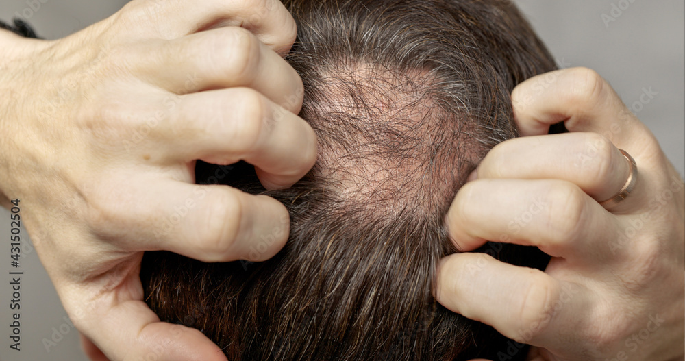 Man with hair loss problems closeup, isolated. Alopecia balding hairs on man scalp. Human alopecia or hair loss - person hand pointing his bald head. Scratching his head. Baldness. Depression, stress