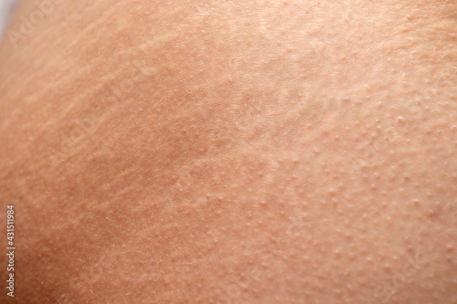 Skin with stretch marks. Stretch marks of butt skin. Female buttocks with stretching marks