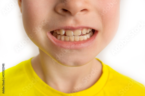 Little girl stands on a white background with a beautiful smile  children crooked teeth  pediatric dentistry. Crooked teeth close-up. Correction of malocclusion is required.
