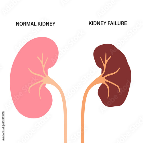 Kidney disease concept