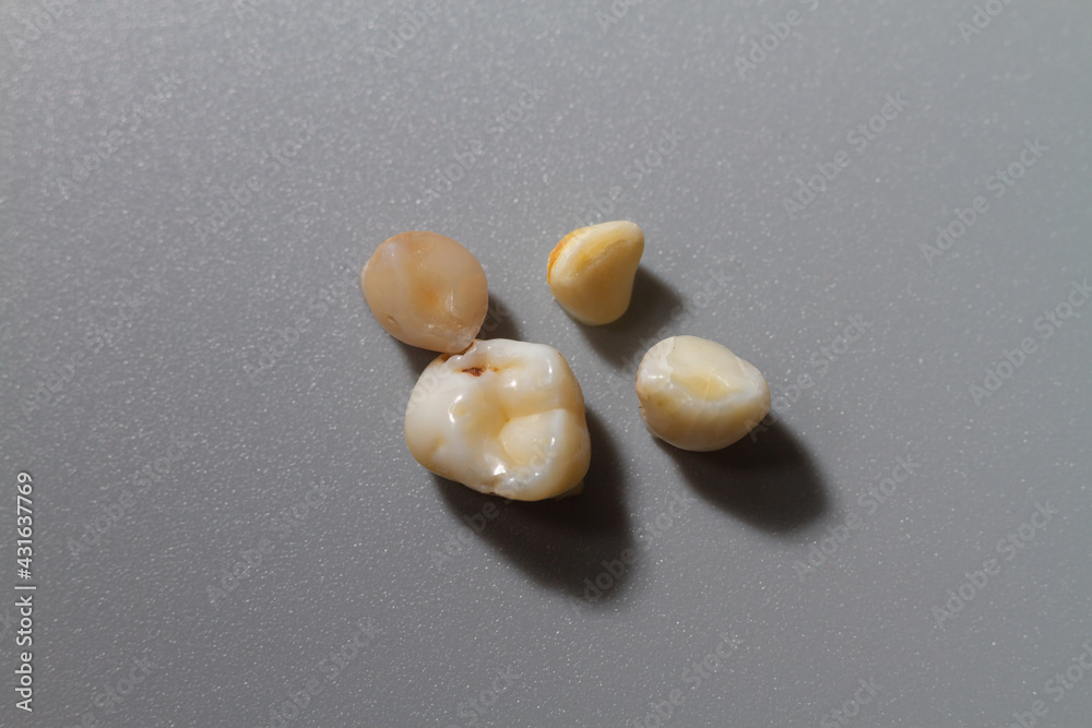 A child's lost baby tooth with traces of caries on a gray background