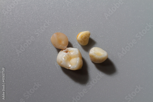 A child's lost baby tooth with traces of caries on a gray background