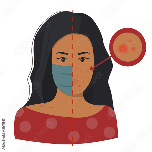 Maskne concept. Acne caused wearing face mask due to coronavirus pandemic. Flat dark skin brunette Indian Asian female character portrait struggling with pimples. Acne closeup vector illustration