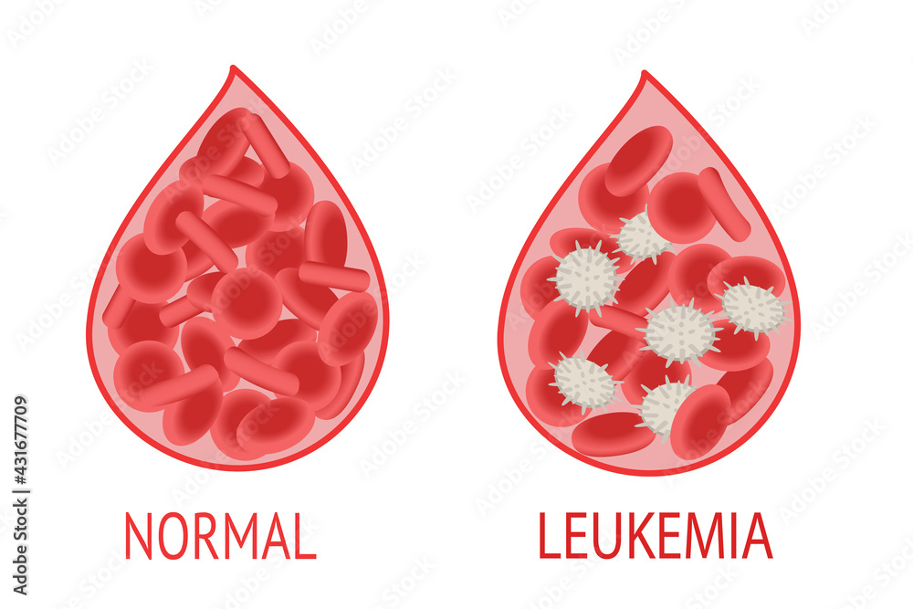 Leukemia. Comparison of a drop of blood with normal and leukemic blood