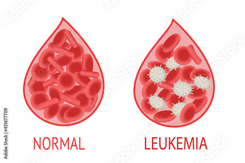Leukemia. Comparison of a drop of blood with normal and leukemic blood cells. Isolated vector image on white background. photo