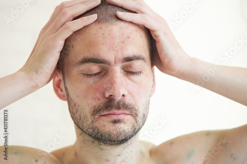 Tableau sur toile Body of adult  man have spotted, red pimple and bubble rash from chickenpox or varicella zoster virus