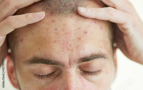 Obraz na plátně Body of adult  man have spotted, red pimple and bubble rash from chickenpox or varicella zoster virus