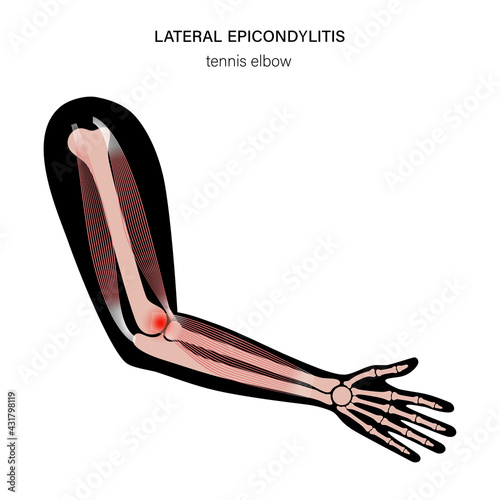 Lateral epicondylitis tennis elbow