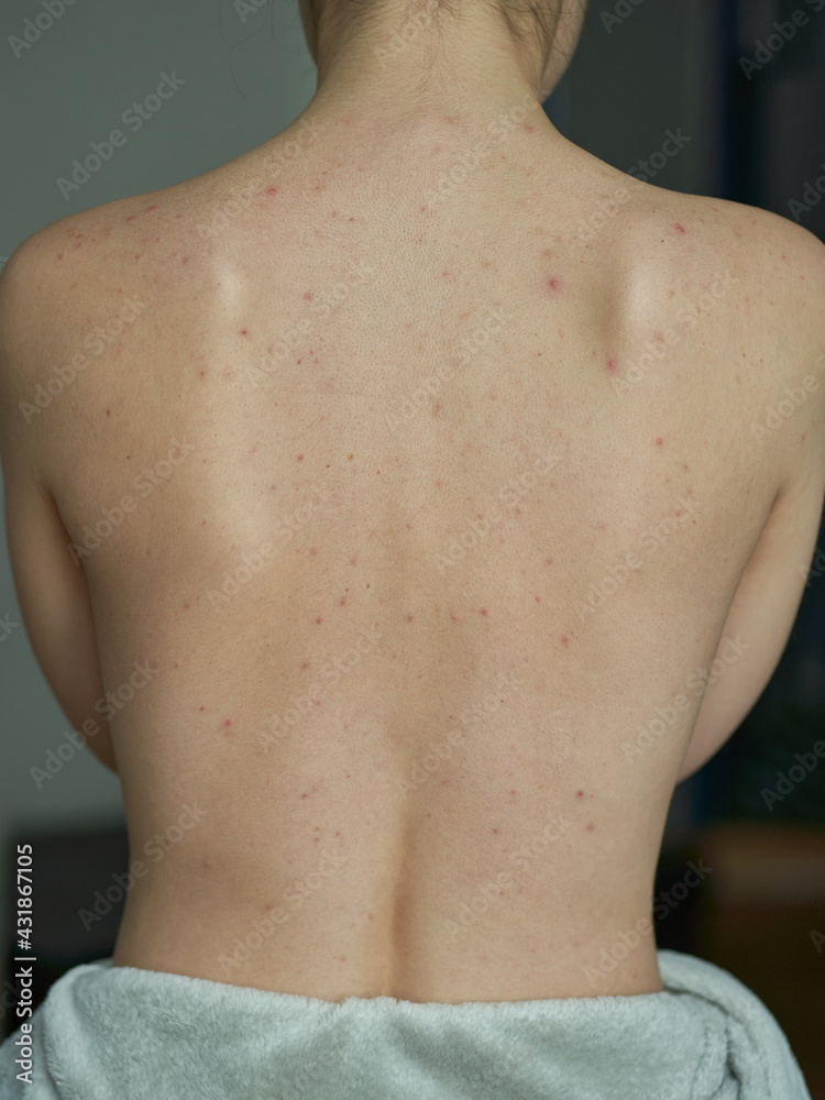 Female back with acne. Skin care problems. Young girl with allergy on her skin. Dermatology concept Female back with acne. Skin care problems. Young girl with allergy on her skin. Dermatology concept