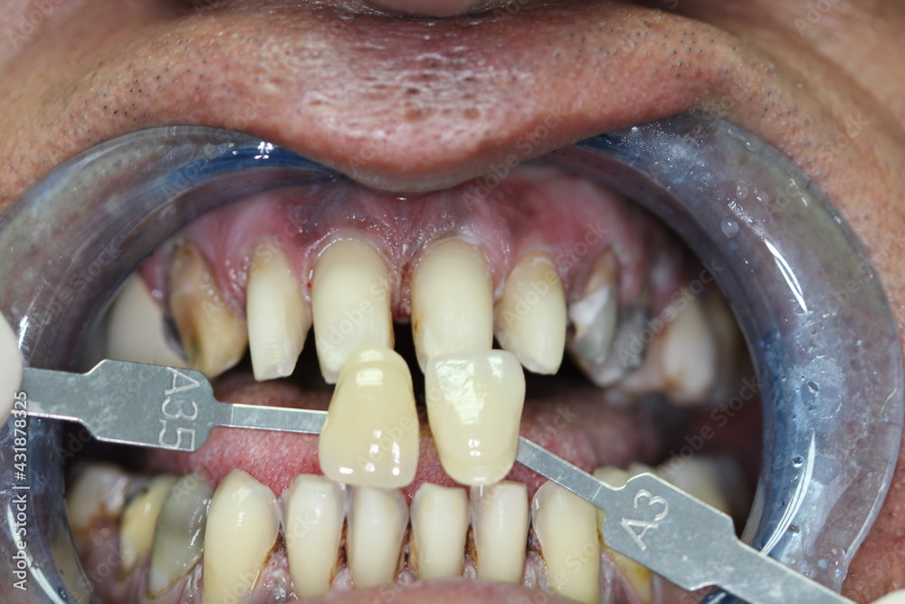 Obraz premium new teeth for the patient. new smile. match the color with the teeth.