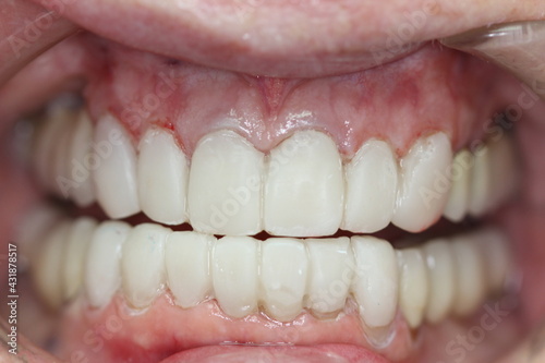 new teeth for the patient. new smile. match the color with the teeth. 