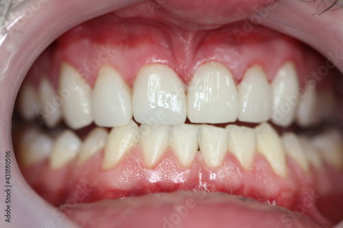 new teeth for the patient. new smile. match the color with the teeth. 