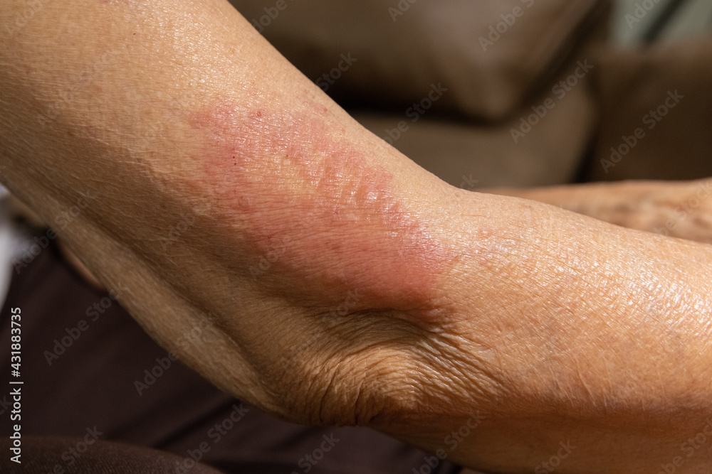 vaccine covid 19 allergies symptom in elderly after vaccination. vaccine covid 19 allergies symptom in elderly after vaccination.