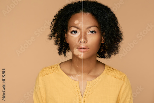 Compare woman face with and without vitiligo. Vitiligo skin pigmentation treatment photo