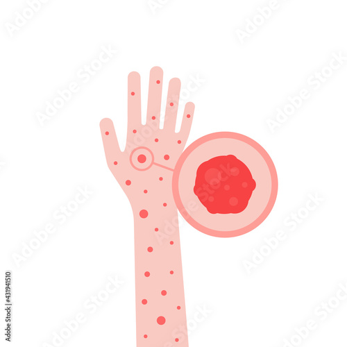cartoon hand with psoriasis or eczema