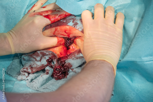 in the operating room a hematoma of a patient is operated by a doctor photo
