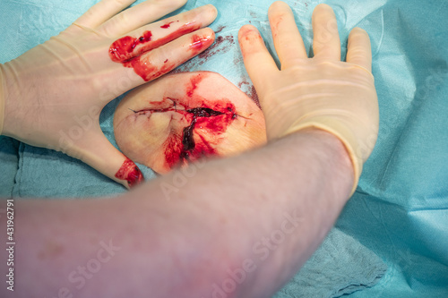 in the operating room a hematoma of a patient is operated by a doctor photo
