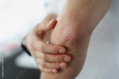 Canvas Print Male elbow and flaky skin and psoriasis