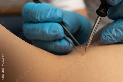 Removing a mole on the body close-up. Instruments, tweezers, medicine, procedure, beauty, skin