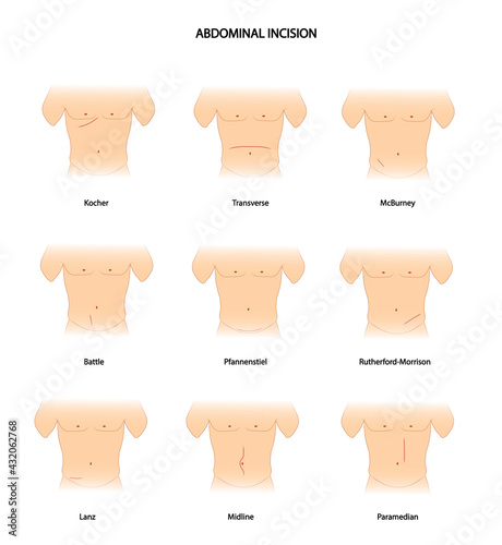 Abdominal Incision. Different types of abdominal incision. Surgery incision  