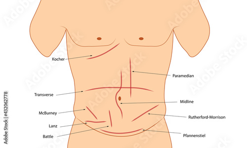 Abdominal Incision. Different types of abdominal incision. Surgery incision  