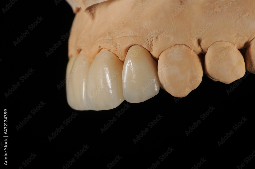 Obraz premium Dental zirconia crowns in the plaster model