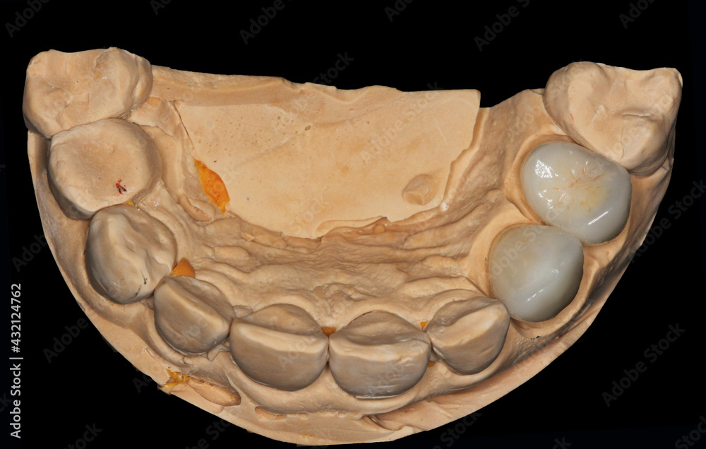 Naklejka premium Dental zirconia crowns in the plaster model