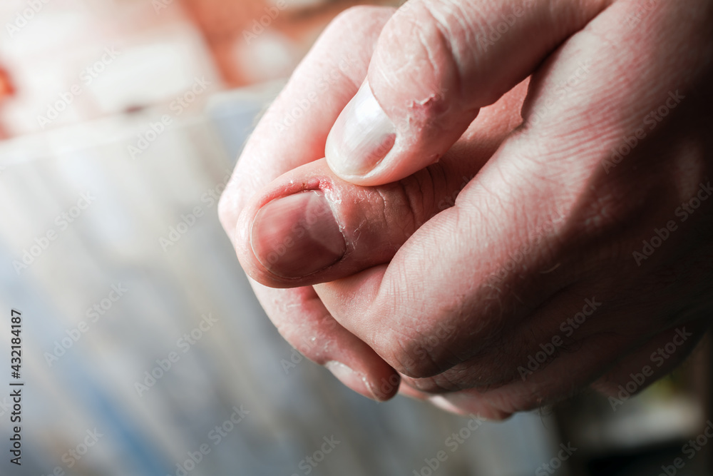 Guy Holding His Bitten Bleeding Thumb, Hands Have Dry Skin Guy Holding His Bitten Bleeding Thumb, Hands Have Dry Skin