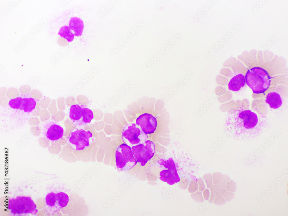 Acute promyelocytic leukemia cells or APL, analyze by microscope ...