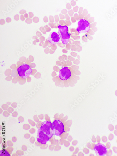 Acute promyelocytic leukemia cells or APL, analyze by microscope, original magnification 1000x photo
