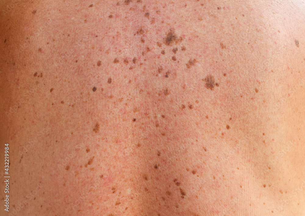 Fototapeta premium Close-up detail of a man's back showing bare skin with scattered moles and freckles, melanoma. Pigmentation. Birthmarks on skin, Possible benign moles , effects of the sun on the skin.