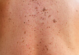 Close-up detail of a man's back showing bare skin with scattered moles and freckles, melanoma. Pigmentation. Birthmarks on skin, Possible benign moles , effects of the sun on the skin.
