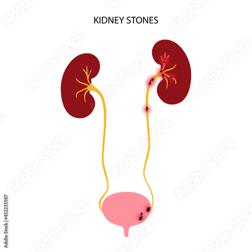 Kidney disease concept