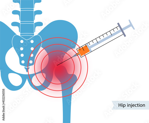 Hip joint injection