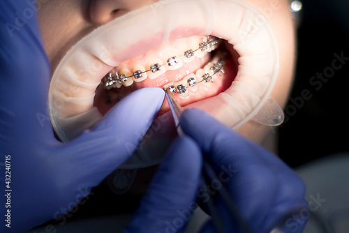 Dental manipulation with braces