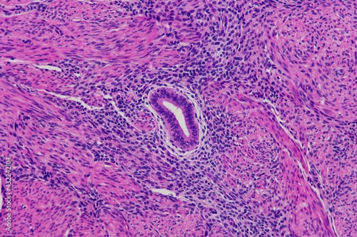Billede på lærred Endometrial gland and stroma surrounded by muscle in a painful condition called adenomyosis of the uterus