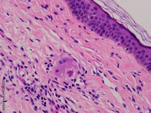 Actual high power microscopic photograph of a star shaped asteroid body within a macrophage cell in the skin. Some lymphocytes are nearby. photo