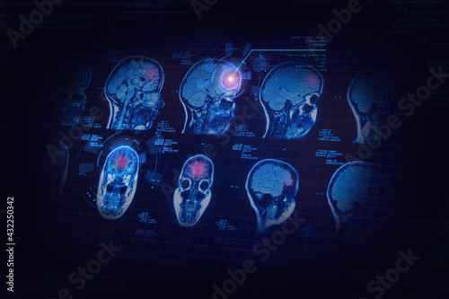MRI brain scan with dangerous point, artificial intelligence in smart healthcare diagnostic technology, AI analised computer tomography