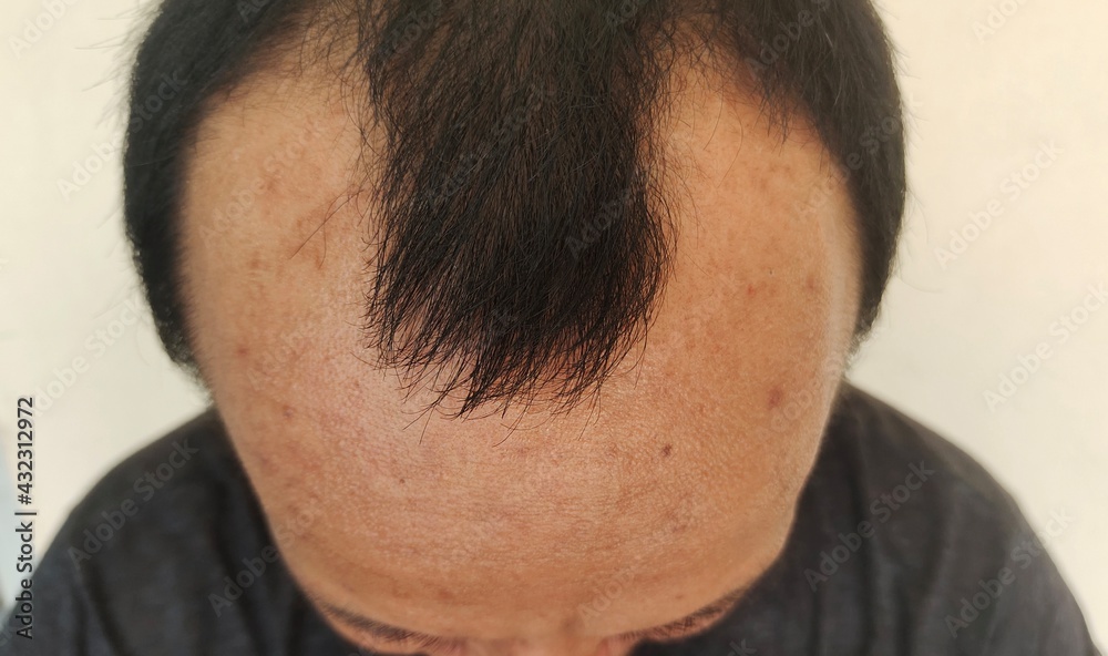 Obraz premium Men of hair loss and bald.