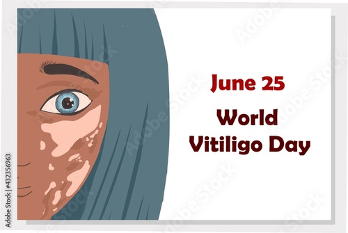June 25 - World Vitiligo Day. Pigmentation disorders. Skin depigmentation. Vector illustration on the theme of rare diseases. Chronic skin disease